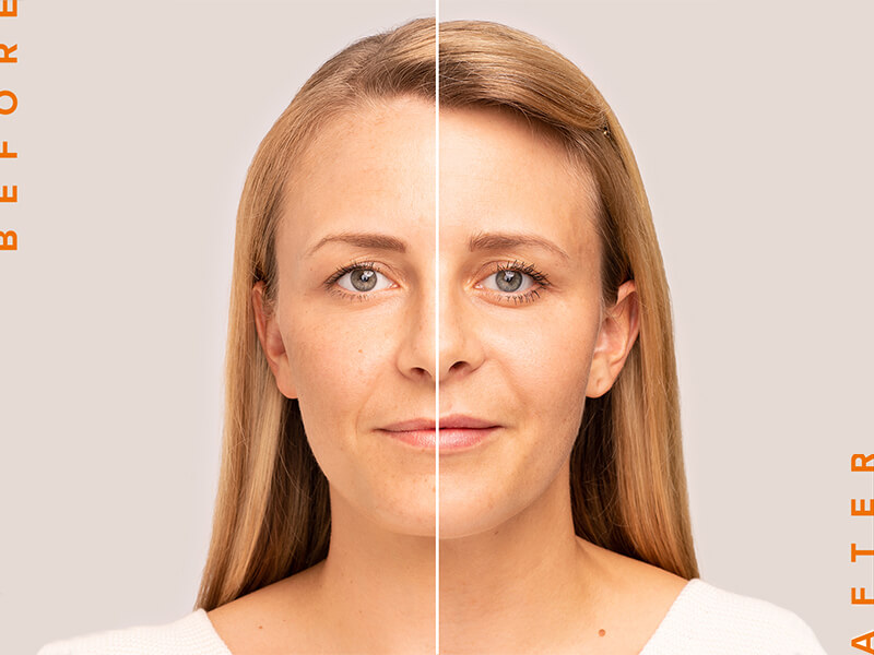 voor - na foto hyaluronzuur behandeling en injectie