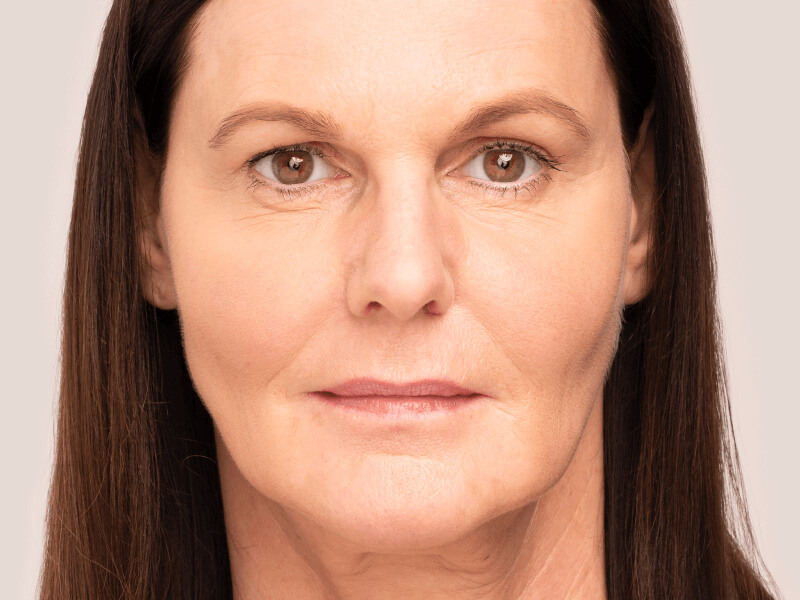 Belotero-filler-hyaluronzuur-na-foto