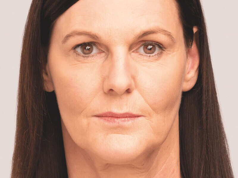 Belotero-filler-hyaluronzuur-voor-foto
