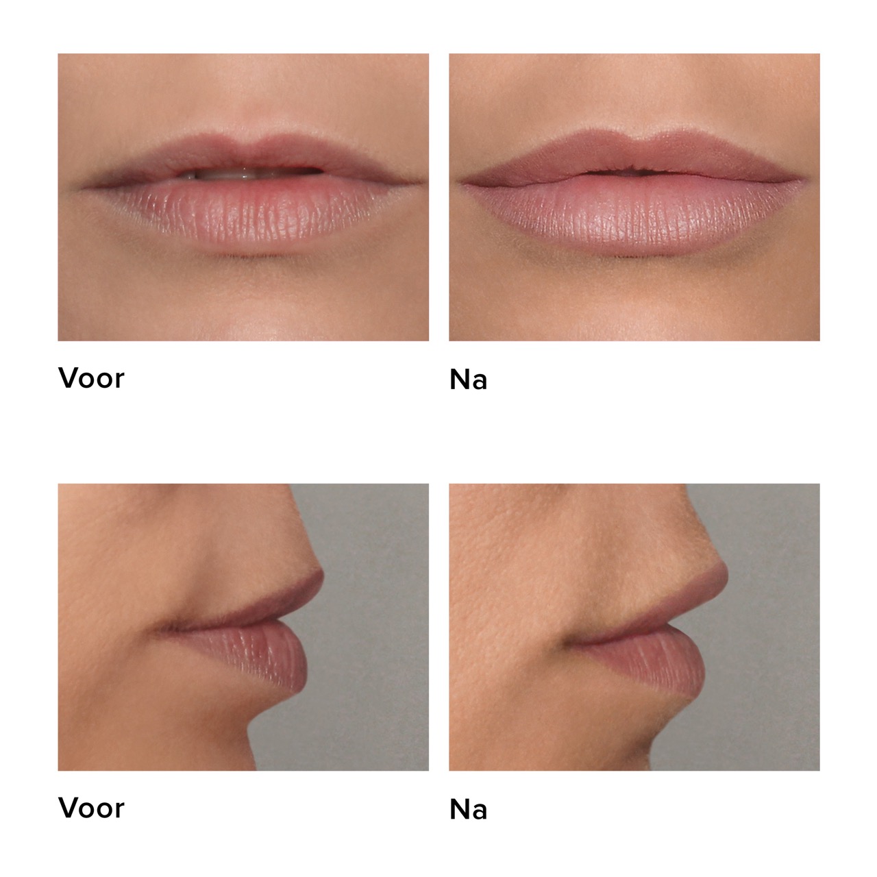 Belotero injectie volle lippen voor en na foto
