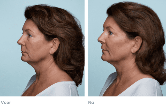 Een vrouw met rijpe huid voor en na de behandeling.