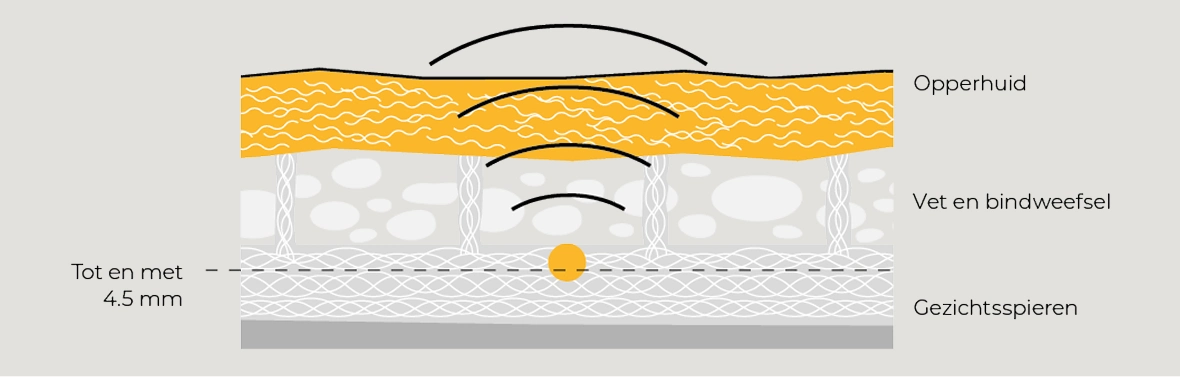 Diagram in drie stappen van het effect van ULTHERAPY®.