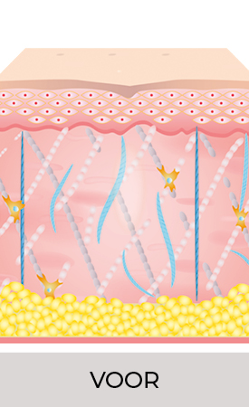 Een diagram van de huid voor de Ultherapy PRIME®-behandeling, met verzwakte collageen- en elastinevezels.