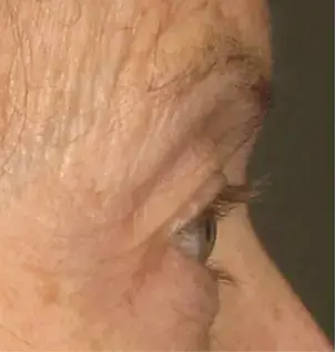 Zij-aanzicht van het oog van een vrouw met rijpe huid, voor de Ultherapy-behandeling.