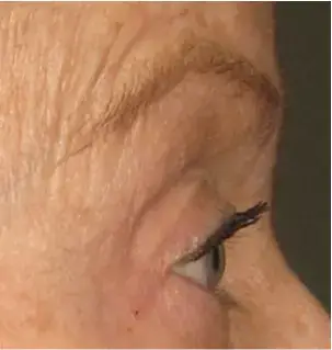 Zij-aanzicht van het oog van een vrouw met rijpe huid, na de Ultherapy-behandeling.